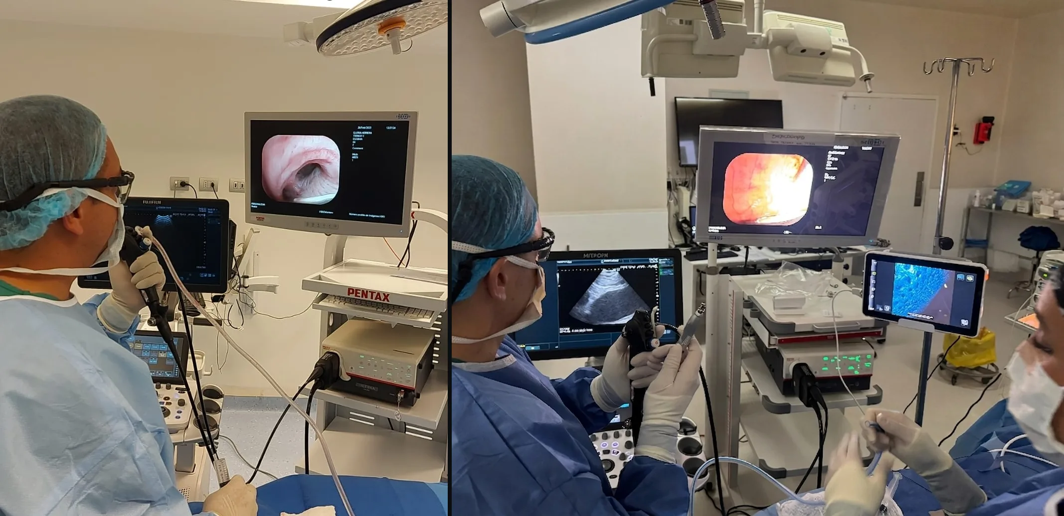 Broncoscopio flexible para diagnóstico endoscópico de las vías respiratorias y procedimiento CryoEBUS: biopsia mediastínica con criosonda guiada por ultrasonido endobronquial